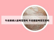 牛皮癣病人能喝雪菊吗 牛皮廨能喝菊花茶吗
