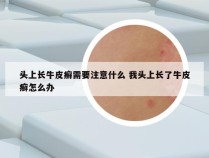 头上长牛皮癣需要注意什么 我头上长了牛皮癣怎么办