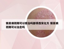 银屑病初期可以根治吗都择西安北方 银屑病初期可以治愈吗