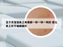 五个月宝宝身上有像癣一样一块一块的 婴儿身上长干燥癣图片