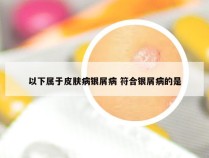 以下属于皮肤病银屑病 符合银屑病的是