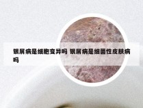 银屑病是细胞变异吗 银屑病是细菌性皮肤病吗