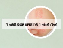 牛皮癣是微循环出问题了吗 牛皮肤癣扩散吗