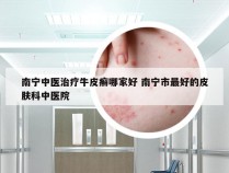 南宁中医治疗牛皮癣哪家好 南宁市最好的皮肤科中医院