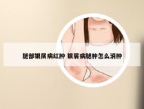 腿部银屑病红肿 银屑病腿肿怎么消肿
