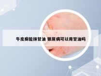 牛皮癣能抹甘油 银屑病可以用甘油吗