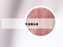 牛皮癣头屑