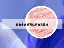 患有牛皮癣可以用自己尿液