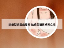 脓疱型银屑病能死 脓疱型银屑病死亡率