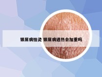 银屑病怕烫 银屑病遇热会加重吗
