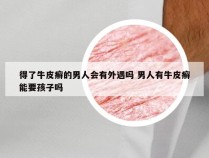 得了牛皮癣的男人会有外遇吗 男人有牛皮癣能要孩子吗