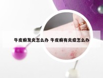 牛皮癣发炎怎么办 牛皮癣有炎症怎么办