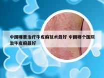 中国哪里治疗牛皮癣技术最好 中国哪个医院治牛皮癣最好