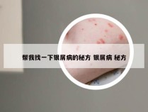 帮我找一下银屑病的秘方 银屑病 秘方