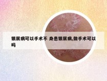 银屑病可以手术不 身患银屑病,做手术可以吗