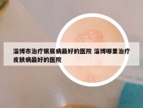 淄博市治疗银屑病最好的医院 淄博哪里治疗皮肤病最好的医院