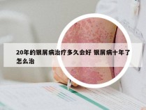 20年的银屑病治疗多久会好 银屑病十年了怎么治
