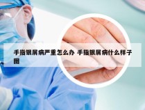 手指银屑病严重怎么办 手指银屑病什么样子图