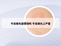牛皮癣头部费钱吗 牛皮癣头上严重