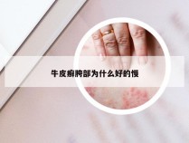 牛皮癣胯部为什么好的慢