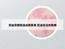 蛇由膏橄榄油治银屑病 蛇油膏治皮肤病