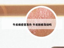 牛皮癣感觉发热 牛皮肤癣发烧吗