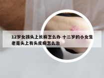 12岁女孩头上长癣怎么办 十二岁的小女生老是头上有头皮癣怎么治
