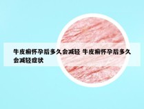 牛皮癣怀孕后多久会减轻 牛皮癣怀孕后多久会减轻症状