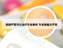 新鲜芦荟可以治疗牛皮癣吗 牛皮鲜偏方芦荟