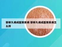 邯郸久病成医银屑病 邯郸久病成医银屑病怎么样