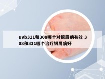 uvb311和308哪个对银屑病有效 308和311哪个治疗银屑病好