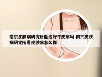 南京皮肤病研究所能治好牛皮癣吗 南京皮肤病研究所看皮肤病怎么样