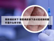 银屑病皮损下 银屑病皮损下去以后皮肤的图片是什么样子的