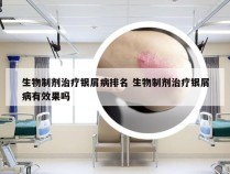 生物制剂治疗银屑病排名 生物制剂治疗银屑病有效果吗