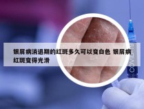 银屑病消退期的红斑多久可以变白色 银屑病红斑变得光滑