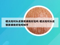 晒太阳对头皮银屑病有好处吗 晒太阳对头皮银屑病有好处吗知乎