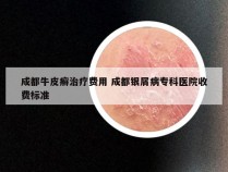 成都牛皮癣治疗费用 成都银屑病专科医院收费标准