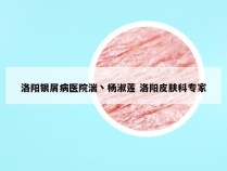 洛阳银屑病医院湍丶杨淑莲 洛阳皮肤科专家