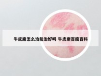 牛皮廨怎么治能治好吗 牛皮廨百度百科