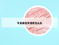 牛皮癣合并湿疹怎么办