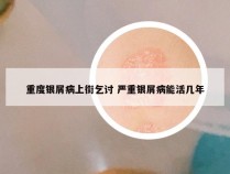重度银屑病上街乞讨 严重银屑病能活几年