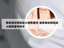 银屑病会降低血小板数量吗 银屑病会降低血小板数量吗知乎