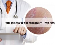 银屑病治疗花多少钱 银屑病治疗一次多少钱