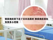 银屑病皮损下去了又长出新的 银屑病皮损处有很多小疙瘩