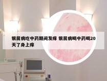 银屑病吃中药期间发痒 银屑病喝中药喝20天了身上痒