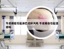 牛皮癣能引起淋巴结肿大吗 牛皮癣会引起湿疹吗