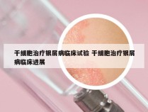 干细胞治疗银屑病临床试验 干细胞治疗银屑病临床进展