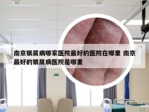 南京银屑病哪家医院最好的医院在哪里 南京最好的银屑病医院是哪里