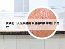 黄芪配什么治银屑病 银屑病喝黄芪有什么功效