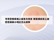 寻常型银屑病上面有大块皮 银屑病皮损上面密密麻麻小嘎达怎么回事